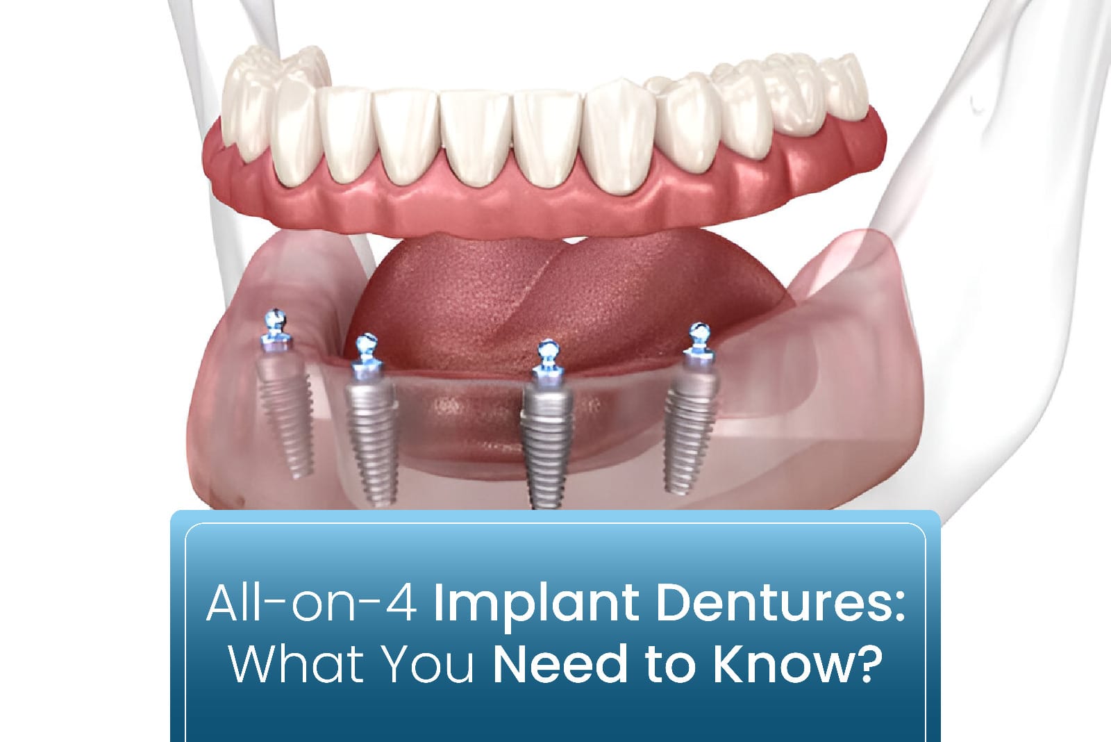All-on-4 Implant Dentures: What You Need to Know