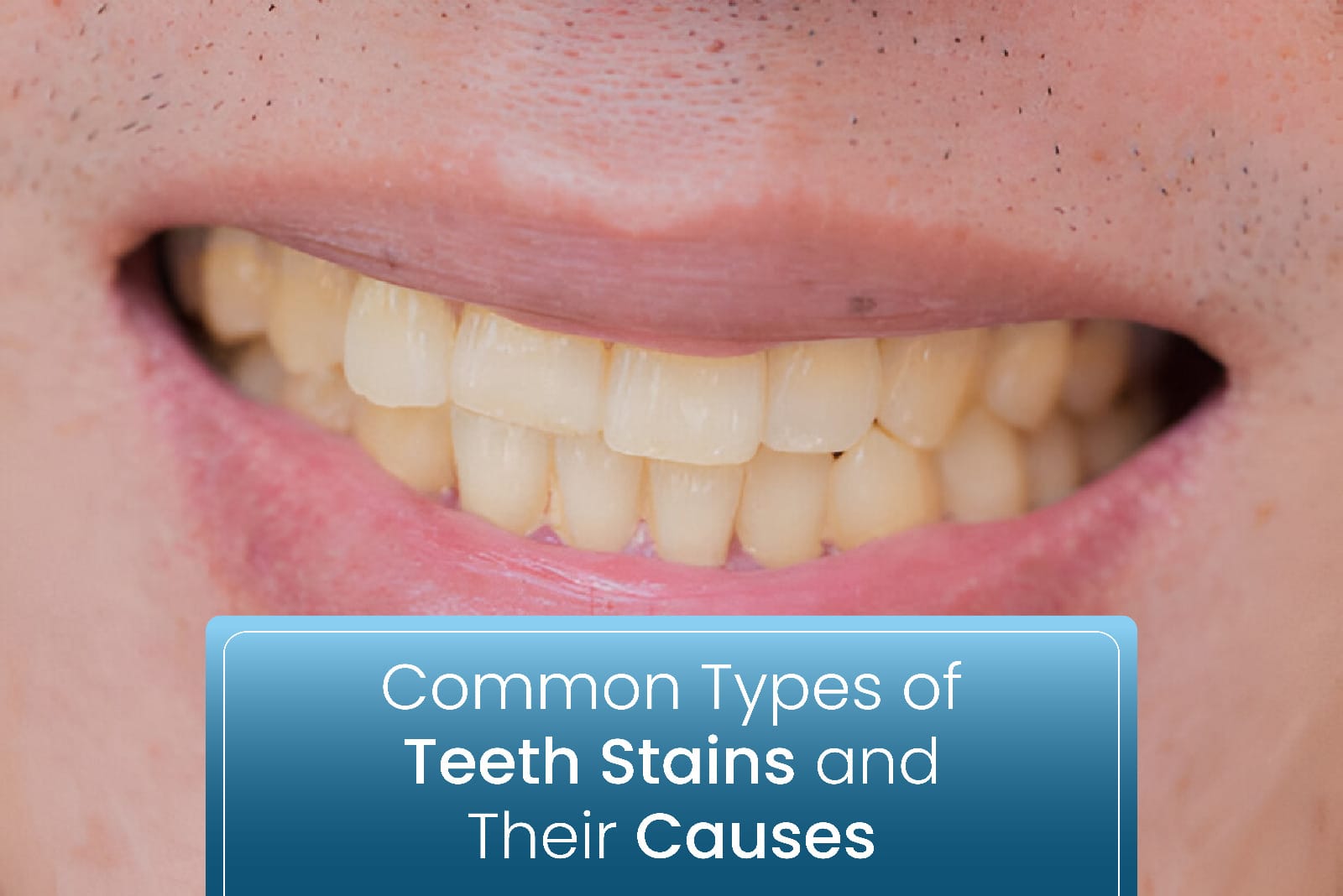 Common Types of Teeth Stains and Their Causes