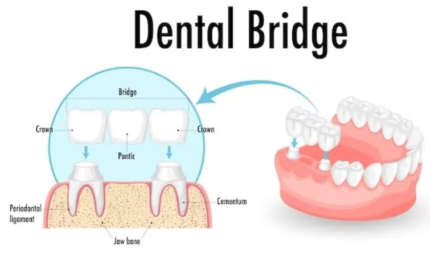 Step-by-Step Guide to Dental Crowns and Bridges Procedure